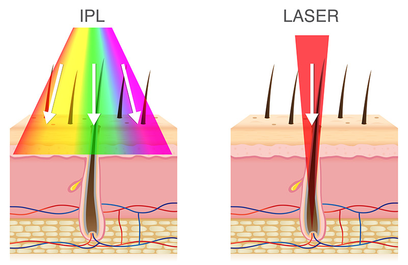 عوارض جانبی IPL در مقایسه با لیزر